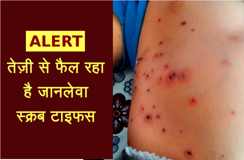 health news तेज़ी से फैल रहा है जानलेवा स्क्रब टाइफस, ऐसे पहचाने लक्षण और करें उपचार