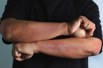 Skin infection can spread during the season of humidity नमी के मौसम में फैल सकता है स्किन इंफेक्शन, एेसे करें बचाव