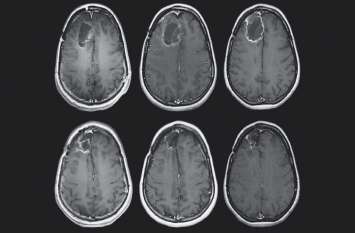 tumor of 120 gram removed from mothers brain महिला के ब्रेन से निकाला 120 ग्राम का ट्यूमर