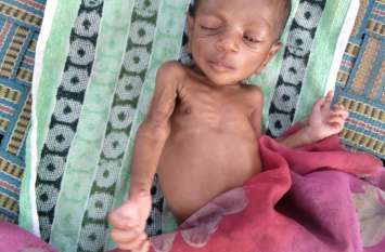 Stigma of Singrauli malnutrition कुपोषण के डेंजर जोन में सिम्प्लेक्स बस्ती, चितरंगी व देवसर विकासखंड भी कई गांव चिह्नित