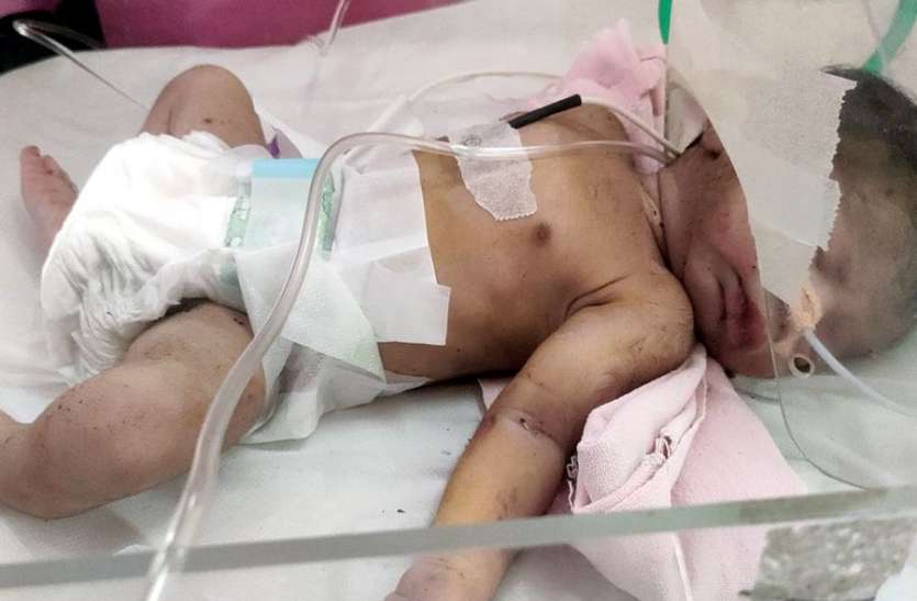 झाडिय़ों में मिला नवजात, हाथ में मिला फ्रैक्चर झाडिय़ों में मिला नवजात, हाथ में मिला फ्रैक्चर