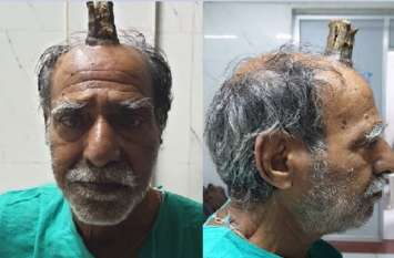 horn grows in head of a 74 years old man in madhya pradesh 74 साल के इस शख्स के सिर पर जानवरों की तरह निकल आई सींग, डॉक्टर भी हैरान