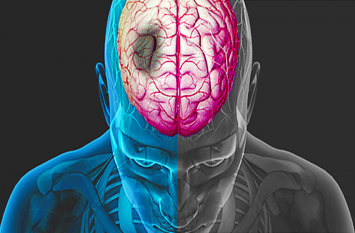 Stress, high BP and sugar can cause brain stroke तनाव, अधिक बीपी और शुगर से हो सकता है ब्रेन स्ट्रोक