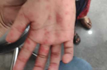 viral spreading among children बच्चों में फैल रहे वायरल से बड़े परेशान