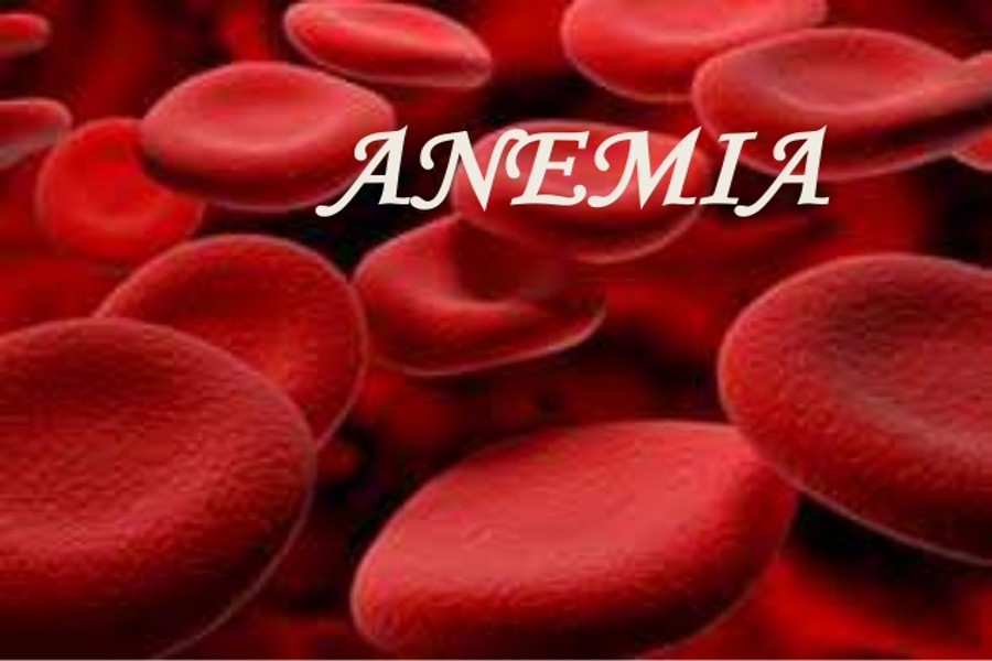 Anemia Is A Big Problem   Anemia 