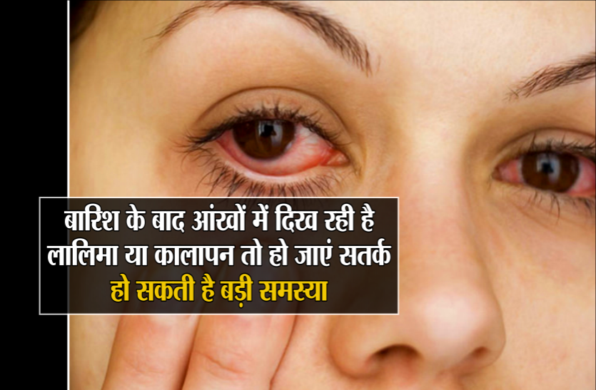 09.png बारिश के बाद आंखों में दिख रही है लालिमा या कालापन तो हो जाएं सतर्क, हो सकती है बड़ी समस्या