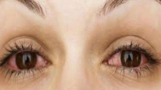 eyes_infection_1535362847.jpg