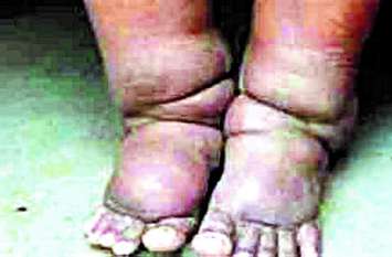 448 patients of filariasis found in district despite government effort सरकारी प्रयास के बाद भी जिले में मिले फाइलेरिया के 448 मरीज