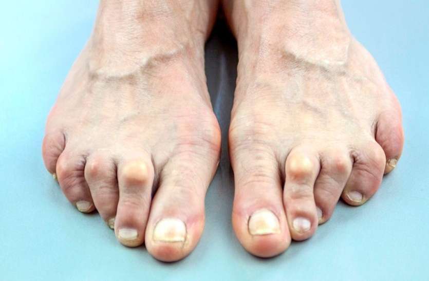 arthritis.jpg Health Is Wealth: अगर आपके हाथ-पैर और जोड़ों में बढ़ रही है सूजन और दर्ज तो तुरंत डॉक्टर से मिलें