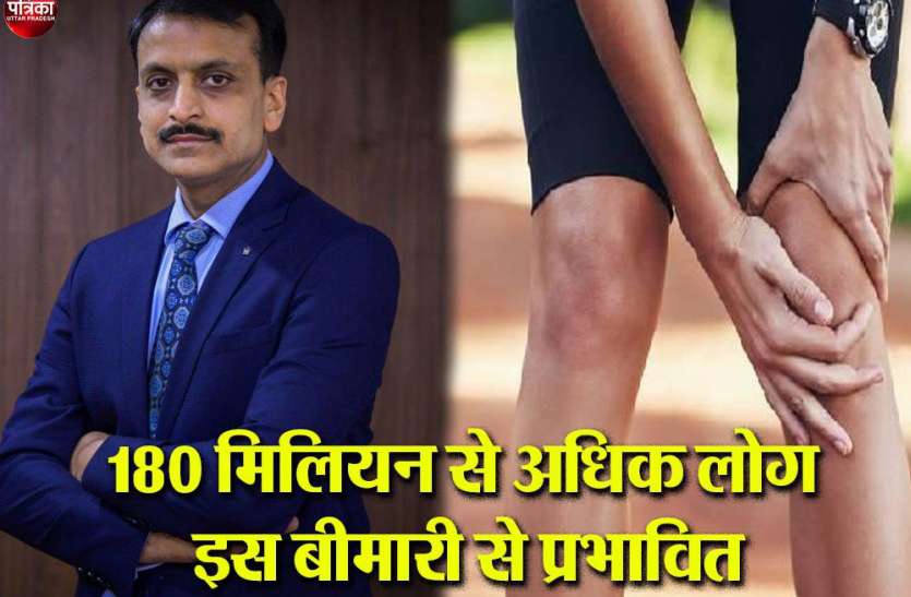 गठिया एक गंभीर महामारी जाने इसके बारे में गठिया एक गंभीर महामारी,जाने इसके बारे में
