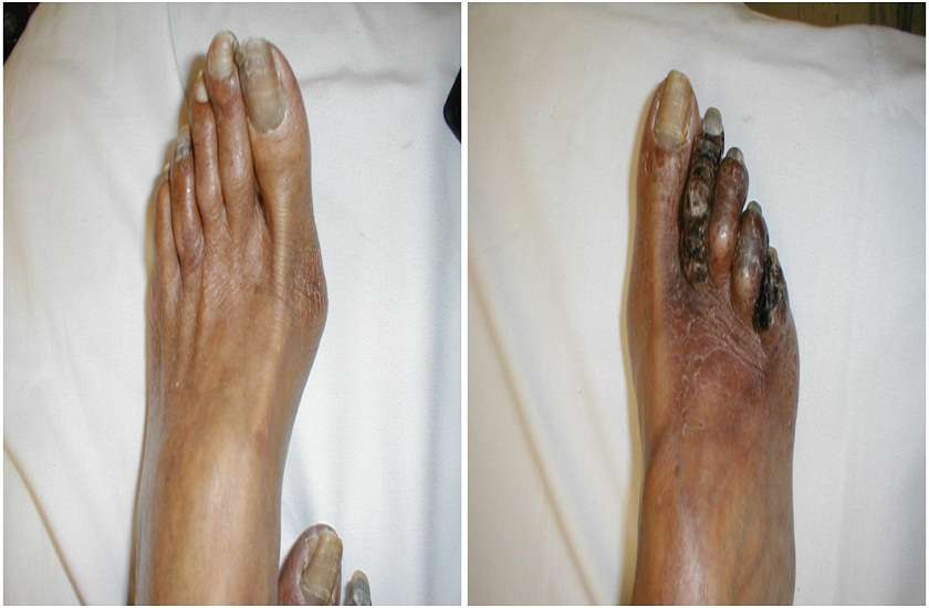 gangrene.jpeg