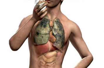 Tuberculosis can occur in organs other than lungs फेफड़ों के अलावा अन्य अंगों में भी हो सकती है टीबी
