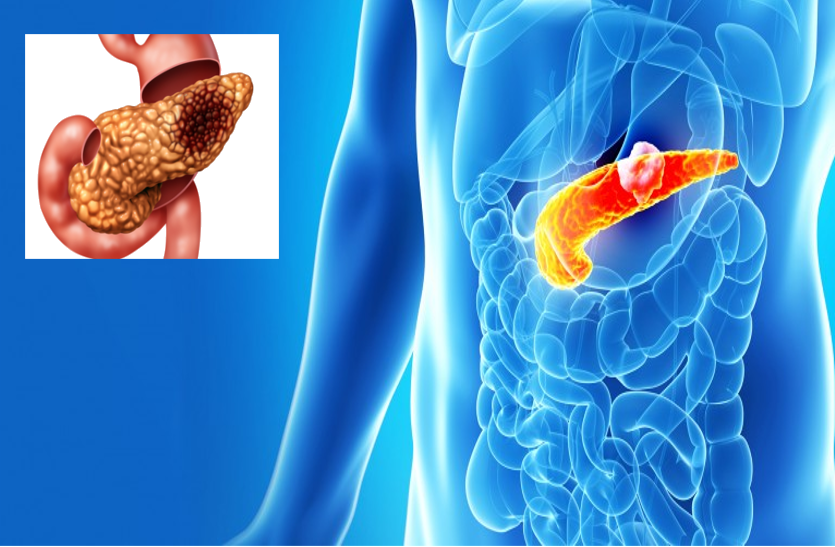 Pancreatic Cancer: Symptoms And Causes - पहली स्टेज में लक्षण नहीं दिखने से  साइलेंट किलर है पेंक्रियाज कैंसर | Patrika News