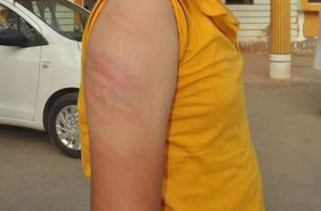 Innocent student beaten with iron pipe, injuries to hands and feet मासूम छात्र को लोहे के पाइप से पीटा, हाथ-पांव में चोटें
