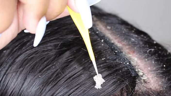 how to stop hair fall immediately | कितने भी झड़ रहे हैं बाल, घर पर बनाकर लगा लें ये हेयर मास्क, तुरंत दिखेगा असर | Patrika News how to stop hair fall immediately | कितने भी झड़ रहे हैं बाल, घर पर बनाकर लगा लें ये हेयर मास्क, तुरंत दिखेगा असर | Patrika News