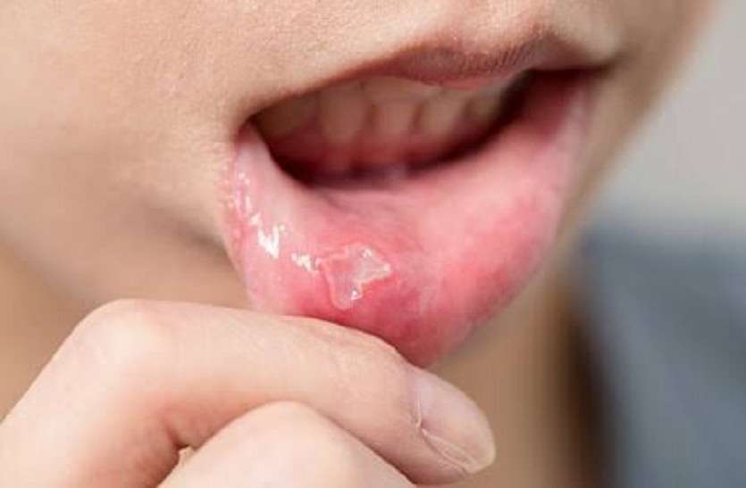 मौसमी फल-सब्जियां ज्यादा खाने से छालों में आराम मौसमी फल-सब्जियां ज्यादा खाने से छालों में आराम