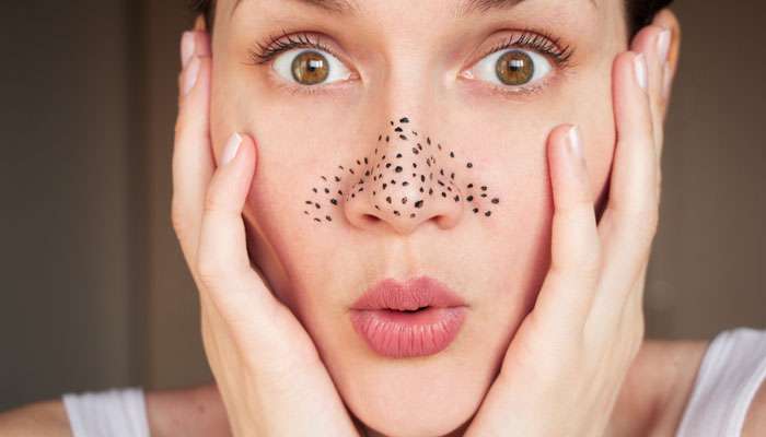blackheads.jpg