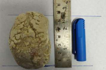 Doctors carried out 7 centimeter stones after performing an operation दर्द होता तो कराह उठता था गरीब का लाडला, फिर डॉक्टरों ने लड़के के पेट से निकाली ऐसी चीज कि देखने वालों ने दांतों तले उंगलियाँ दबा लीं