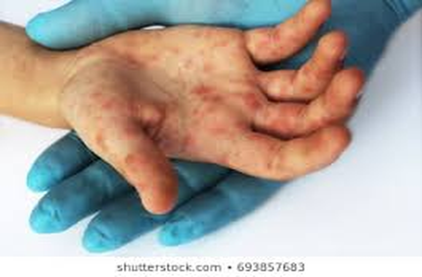 TB Patients Corona Alert : टीबी रोगियों को एक माह की दवा निःशुल्क मिलेगी