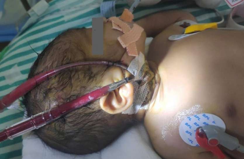 ECMO से बची हाई रिस्क नवजात की जान ECMO से बची हाई रिस्क नवजात की जान