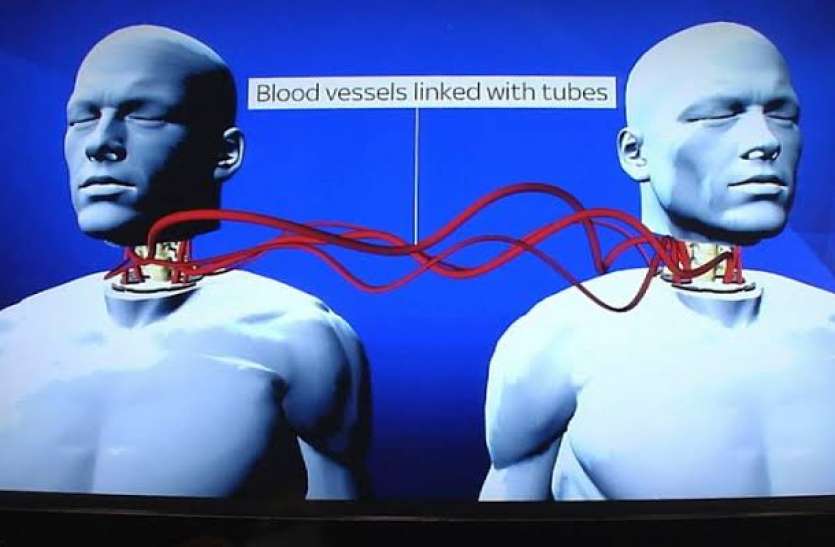 Image result for head-transplant-can-be-possible-in-10-years-britain-scientists-claim