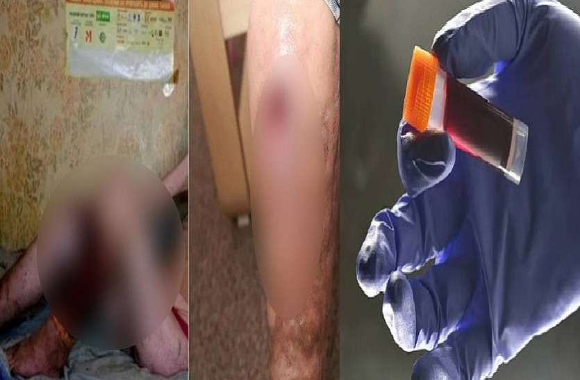 Woman injected intoxicated body now body is rotting OMG! महिला ने शरीर में लगाया था खतरनाक इंजेक्शन, अब सड़ रहा है शरीर