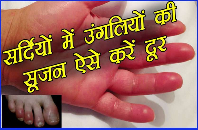 Swelling in Fingers in winter ठंड की वजह से अगर सूज गई है आपकी उंगलियां, तो अपनाएं ये घरेलु उपाय तुरंत मिलेगी राहत