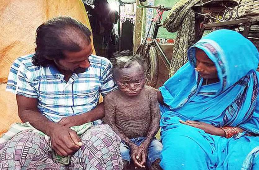 Child with rare disease सांप की तरह खाल छोड़ता है 10 साल का ये बच्चा, लोग बुलाते हैं 'मानव सर्प'