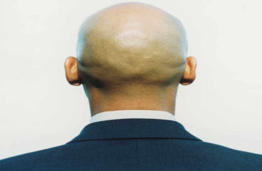 Stressful Lifestyle Responsible for Hair Loss in Men Hair loss: इन कारणाें से झड़ते हैं पुरुषों के बाल, इस तरह करें बचाव