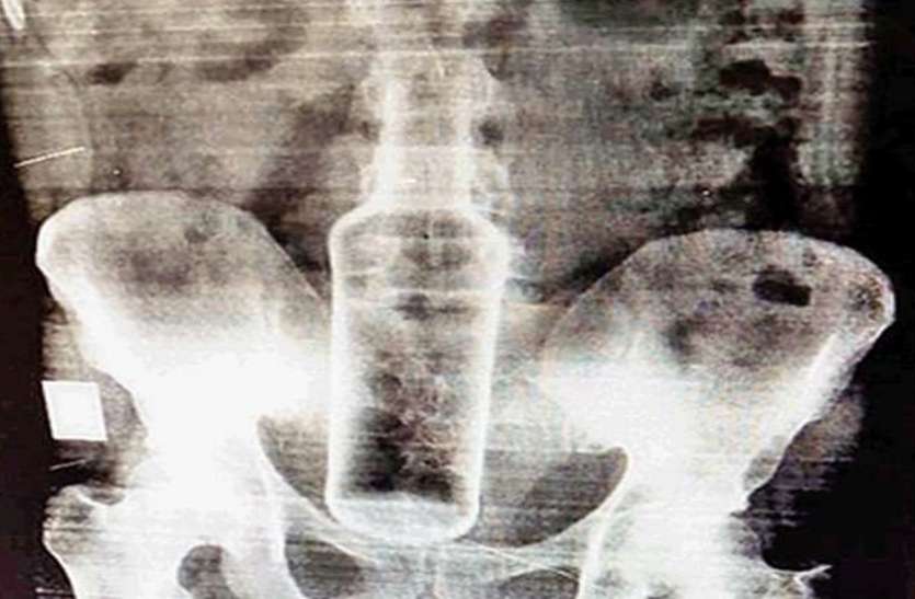 bottle.jpg युवक के प्राइवेट पार्ट में मिली कांच की बोतल, एक्स-रे देख डाॅक्टर भी रह गए हैरान