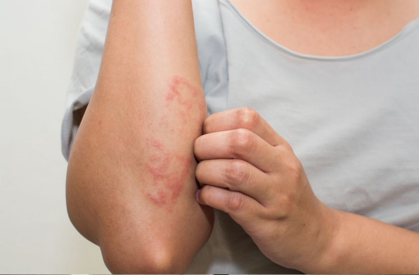 Eczema Treatment Causes And Symptoms Eczema ज न ए बदलत म सम म त वच पर क य ह त ह ख जल और जलन Patrika News