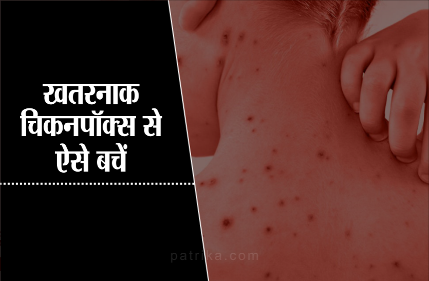 health news तेजी से फैलता है 'चिकन पॉक्स', इस गंभीर बीमारी से ऐसे रखें खुद को दूर