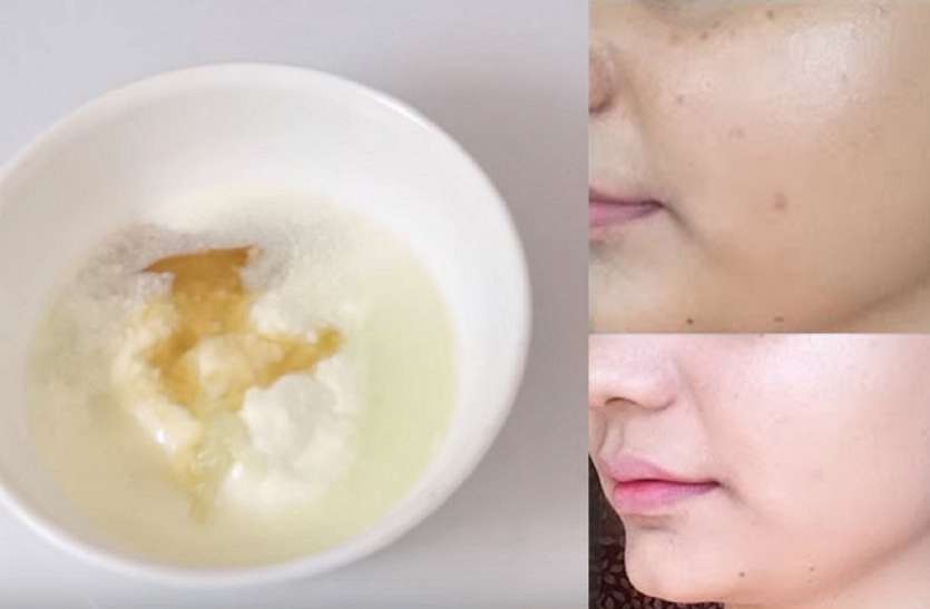 clearskinrecipe.jpg चेहरे के कालेपन को दूर करने के लिए लगाए बस ये 1 चीज, खत्म हो जाएंगे दाग-धब्बे