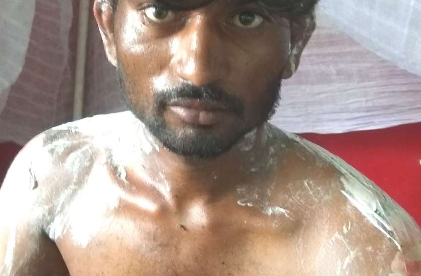 Due to love affair, youth set fire to kerosene on the body प्रेम प्रसंग के चलते युवक ने शरीर पर केरोसीन डालकर लगाई आग
