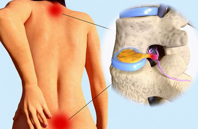 ACUPRESSURE ACUPRESSURE : स्लिप्डडिस्क के दर्द को न करें नजरंदाज, ये उपाय तुरंत देंगे आराम