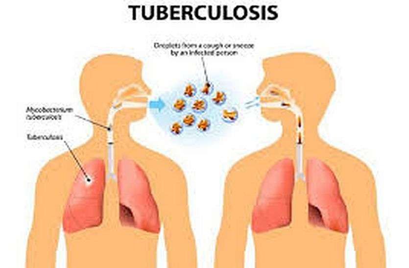 TB will be cured in six months instead of two years in bhilwara दो साल की जगह अब छह महीने में ठीक होगा टीबी