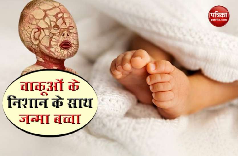 baby1.jpg पश्चिम बंगाल में अजीबो-गरीब बीमारी के साथ जन्मा बच्चा, शरीर पर है चाकू के चीरे जैसे निशान