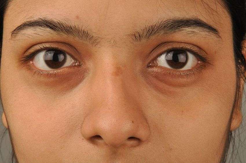 लाइफ स्टाइल: जानिये स्ट्रैस हमारे चेहरे पर क्या असर डालता है?