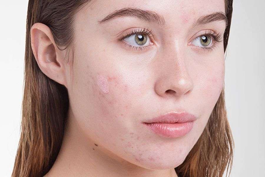 लाइफ स्टाइल: जानिये स्ट्रैस हमारे चेहरे पर क्या असर डालता है?