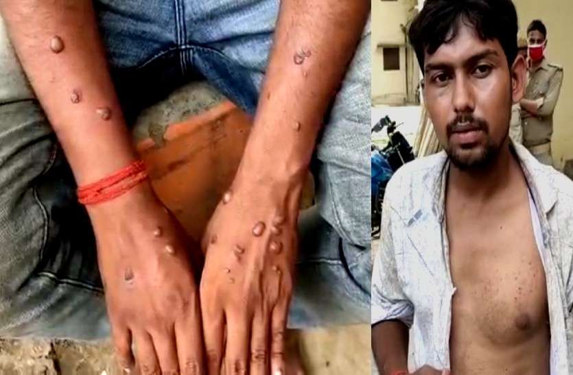 Boyfriend Torture प्रेमिका के घरवालों ने प्रेमी को 4 दिनों तक बंधक बनाकर पीटा, शरीर पर जगह-जगह सिगरेट से जलाया
