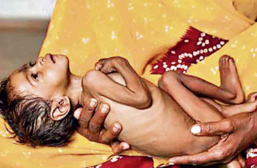 12 thousand children suffering from malnutrition in the district आपकी बात, कुपोषण की समस्या का समाधान कैसे हो सकता है?