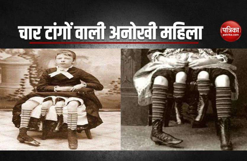 Myrtle Corbin चार टांगों वाली अनोखी महिला, जिसने पूरी दुनिया को चौकाया