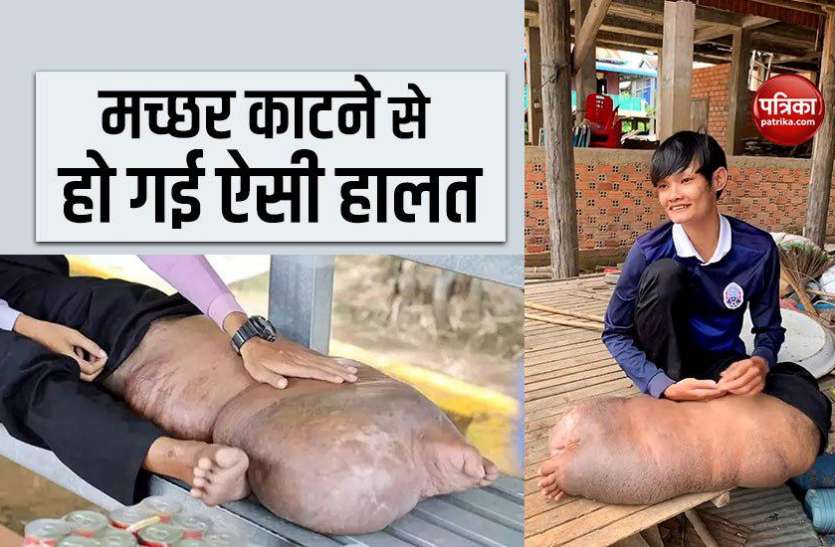 Bong Chet मच्छर के काटने से गुब्बारे जैसा फूल गया पैर, स्कूल छूट गया और टूट गए सारे सपनें
