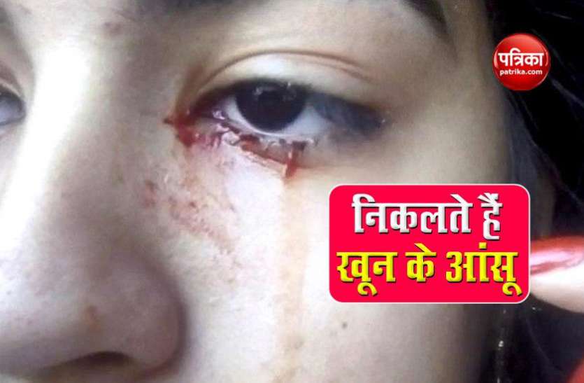 Doris अजीबोगरीब बीमारी से जुझ रही है ये लड़की, खून के आंसू देख डॉक्टर्स भी रह गए दंग