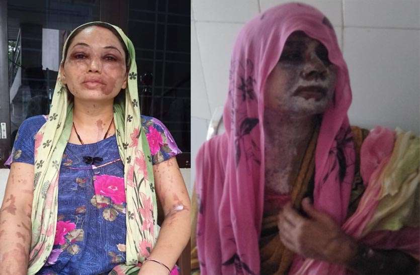 कीटनाशक को खोलने के दौरान दवा से दो आशा सहयोगिनी झुलसी कीटनाशक को खोलने के दौरान दवा से दो आशा सहयोगिनी झुलसी