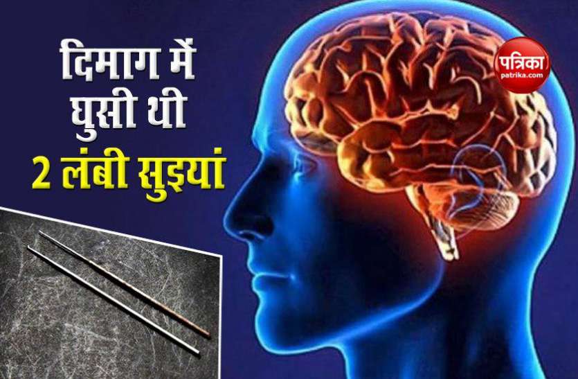 two needles deep in brain दिमाग में घुसी थी 2 लंबी सुइयां, जी रही थी ऐसी जिंदगी