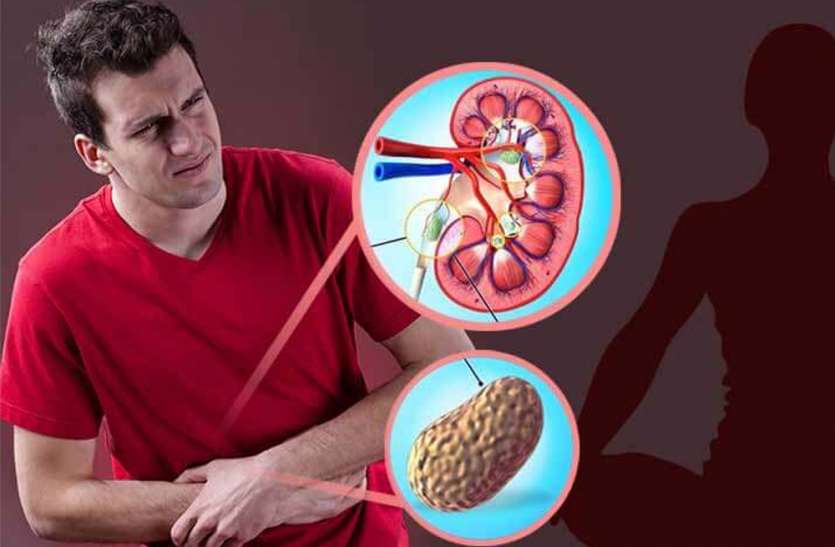 kidney stone medicine आसानी से निकलेगा किडनी से स्टोन, आ गई है हर्बल दवा