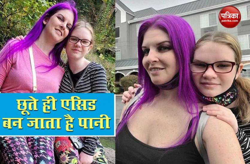 water turns acid इस लड़की के शरीर को छूते ही एसिड बन जाता है पानी, पड़ जाते हैं फफोले