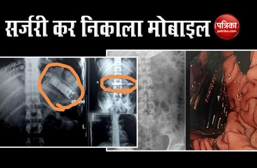 stomach after surgery महंगा पड़ा दोस्तों संग प्रैंक करना, 7 महीने तक पेट पर बजता रहा मोबाइल