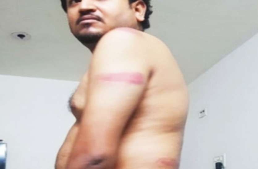 brutality : मास्क के लिए बेरहमी से पीटा, शरीर पड़े कई निशान brutality : मास्क के लिए बेरहमी से पीटा, शरीर पड़े कई निशान